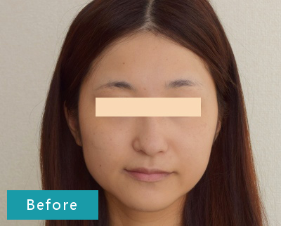 検証 顔そりエステの効果はいつまで続く 肌の変化をレポート うる肌コラム