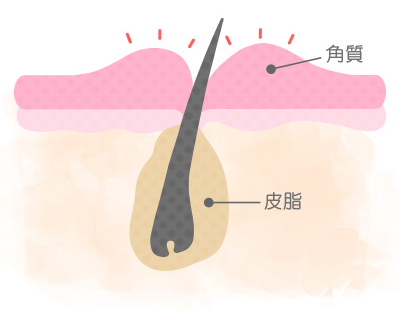 顔ダニのエサとなる古い角質・産毛を除去してくれるから