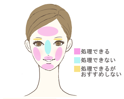 広い部分は処理できる。逆に凹凸のある部分は難しい