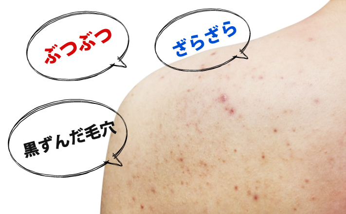 背中が汚く見えるのは毛穴のせい 対策方法はこれ うる肌コラム