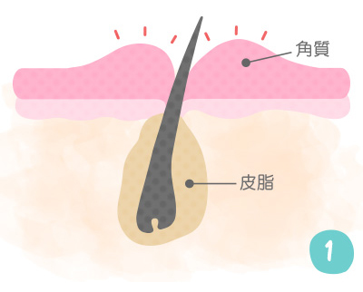 背中が汚く見えるのは毛穴のせい 対策方法はこれ うる肌コラム