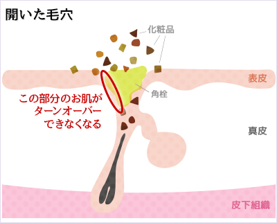 小鼻のポツポツ・イチゴ鼻（角栓）ができるメカニズム